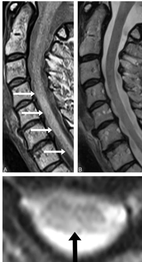 FIG 3. A C5–C7 lesion (imaging and correlates with axial GRE imaging (A, white arrows) is seen on sagittal PD-FSEC, black arrow)