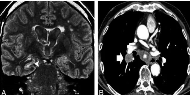 FIG 1. A 62-year-old man with subacute cognitive impairment and seizures. A, An enlarged andhyperintense right hippocampus in a coronal FLAIR image (arrowhead)