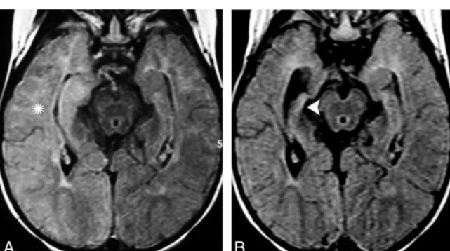 FIG 7. A previously healthy 67-year-old man presented with a transient isolated episode of partial complex seizures and dysphasia