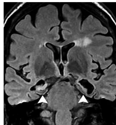 FIG 9. A 45-year-old woman presented with strokelike episodesassociated with ﬂuctuating and progressive cognitive impairment.Severe atrophy and bilateral hyperintensity in the hippocampi (ar-rowheads) along with mild cortical atrophy and scattered whitemat