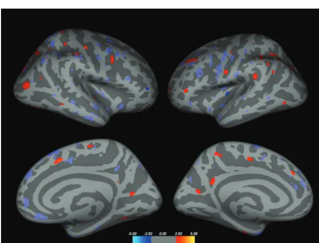FIG 2. Inﬂated brain, displaying areas of reduced cortical thickness (red areas) in CISj comparedcortical thickness in CISnj is reduced compared with CISj