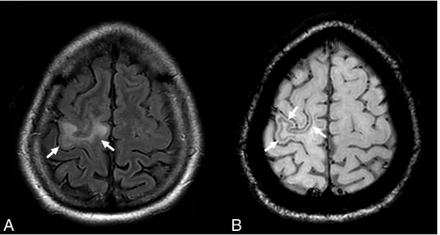 FIG 1. Susceptibility-weighted, FLAIR, and diffusion images in patient 9 with unilobar left frontal NTZ-PML at the asymptomatic stage