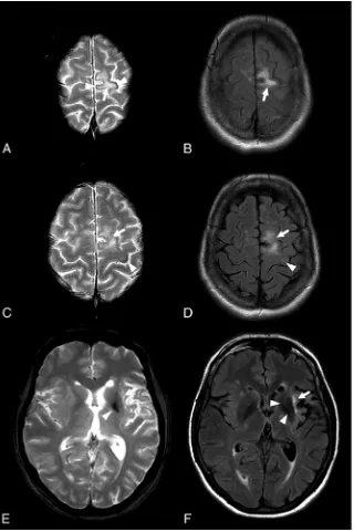 FIG 3. FLAIR and T2* images in patient 7 at the symptomatic stage. Cortical low signal intensity is visible on T2* images (A, arrowheads) adjacentto the hyperintense PML lesion (A–C, arrows)