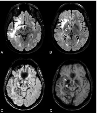 FIG 6. FLAIR and SWI in patient 8 at symptomatic and chronic stages. At the symptomatic stage, an extensive PML lesion is visible on FLAIRlenticular nucleus on FLAIR images (images involving the right frontal and temporal white matter and the brain stem (A