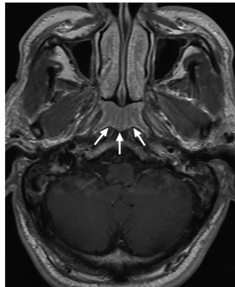 FIG 3. Axial T1-weighted postcontrast MR imaging of a 54-year-oldman with lymphoid hyperplasia