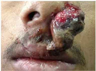 Figure 4.  Radish fleshy mass coming out from left nasal cavity extending till upper lip with widening of nasal ala