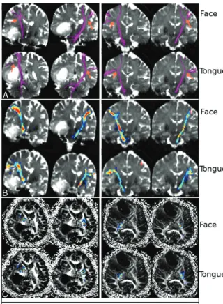 FIG 2. FACT and probabilistic ﬁber tractography results obtained from 2 patients: 1) a 56-year-oldman with glioblastoma, and 2) a 63-year-old woman with brain metastasis (adenoid cystic carci-noma), A, The FACT algorithm was not capable of extracting ﬁbers