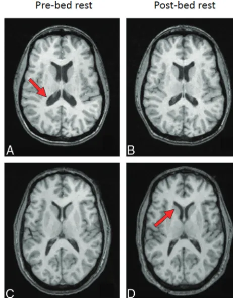 Table 1: Pre- and post–bed rest volumetric MRI and physiologicmeasurements (group mean and SD)
