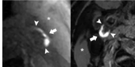 FIG 3. Intraplaque hemorrhage on MR imaging. Carotid bifurcationsinversion recovery turbo ﬁeld echo sequence (Achieva; PhilipsHealthcare)