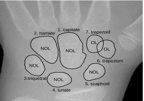 Fig. 1   Carpal region of interest indicate non-overlapping bones (1-5) and  overlapping bones (6-7) with their ground truth boundary