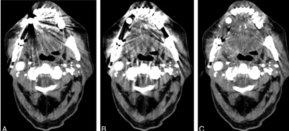FIG 2. The effects of metal artifacts from dental hardware are highest with FBP (A), lower with LIMAR (B), and lowest with IMAR (C); a bettervisualization of the oral cavity was achieved with IMAR (C).
