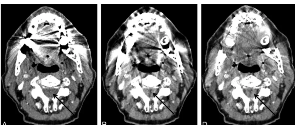 FIG 4. The effects of metal artifacts from dental hardware are highest with FBP (A), lower with LIMAR (B), and lowest with IMAR (C)