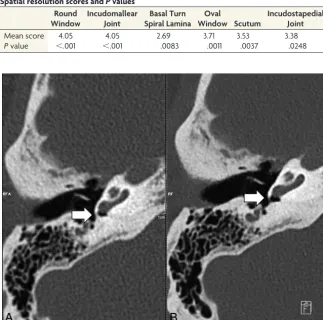 FIG 3. Comparison of the spatial resolution of the incudomallear joint. Representative axialimages of the incudomallear joint of the same patient scanned with the zUHR technique (A) andUHR-IR technique (B)