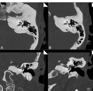 FIG 4. Lower image noise in images acquired with UHR-IR. Imagenoise was measured at the posterior fossa in axial images from each ofthe 13 datasets by using the zUHR and UHR-IR techniques.