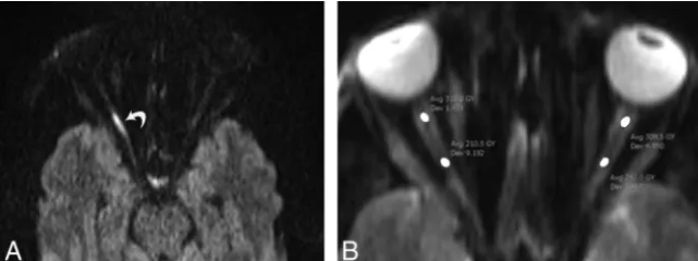 FIG 1. A 37-year-old man with right-sided TON following a motor vehicle collision. Axial diffusion-weighted image (A) shows hyperintensity of the posterior segment of the optic nerve (curvedarrow) due to restricted diffusion