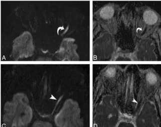 FIG 2. A 64-year-old man with left-sided TON following a fall. Axial diffusion-weighted image (A) andADC map (B) show concomitant extension of hyperintensity into the anterior segment of optic nerve(curved arrow), with corresponding hypointense signal on t