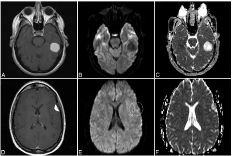 FIG 1. Three different cases of chordoid meningioma show the characteristic T1, T2 FLAIR, and postcontrast T1 appearances, which are similar tothose of other meningioma subtypes