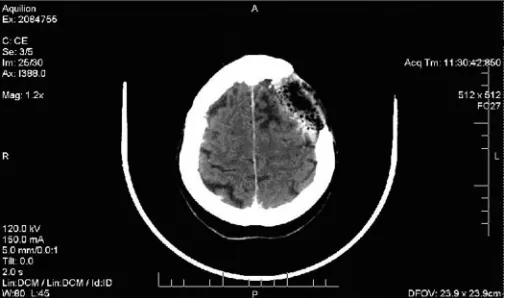Figure 1 Contrast enhanced computed tomography taken of patient in March, 2000 showing surgical site