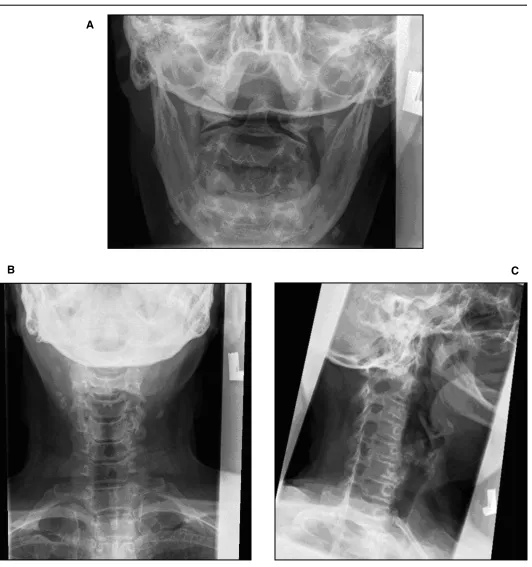 Figure 2 Five view cervical spine radiographic series taken approximately 18 months prior to initial chiropractic visit showing degenerative changes at C5, C6 and C7.