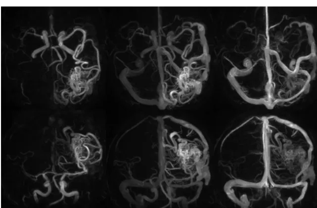 FIG 2. Right temporal lobe AVM. Top row: 3 HYPRFlow images from the 60-image dynamic series.Arterial (A), mixed (B), and venous phase (C) images are displayed