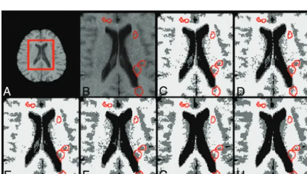 FIG 3. Percentage of voxels in WML regions having been classiﬁed asGM (top) and WM (bottom) for each segmentation method and hos-pital, H1 (�), H2 (�) or H3 (E)