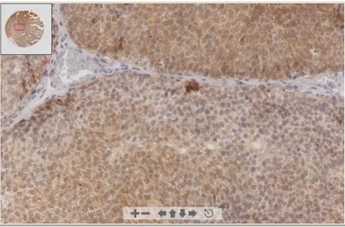 Figure 2Digital image of TMA spot presented in VTM using Zoomify™ applicationDigital image of TMA spot presented in VTM using Zoomify™ application