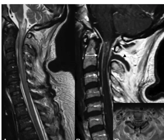 FIG 3. Evolution of ischemia. The ﬁrst MR image shows the subtle signal anomaly on T2 and diffusion sequences (hours later shows an important tumefaction and high signal on T2WI associated with a restriction of diffusion of the cervical spinal cord at theC