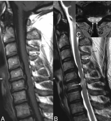 Table 2: Technical MR imaging parameters of the spinal cordprotocol at 1.5T