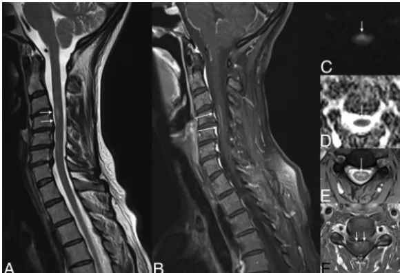 FIG 6. Subacute ischemia. Note the slight hypersignal of the spinal anterior territory at the levelof C4–C6 on T2WI (arrows, A and E), associated with a restriction of diffusion (arrows, C and D)and enhancement (arrows, D).