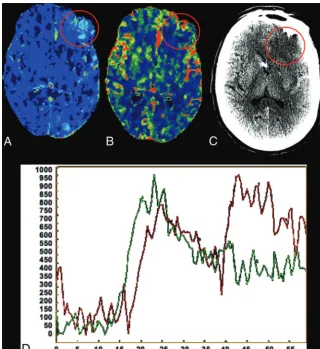 FIG 3. CTP performed on day zero of admission in a representative patient with SAH (samepatient as shown in Fig 1)