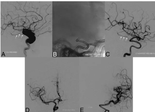 FIG 1. Baseline pretreatment digital subtraction angiogram (lateral projection, A) demonstrating alarge dysplastic ICA aneurysm with preserved antegrade ﬂow in the anterior choroidal artery(white arrows)