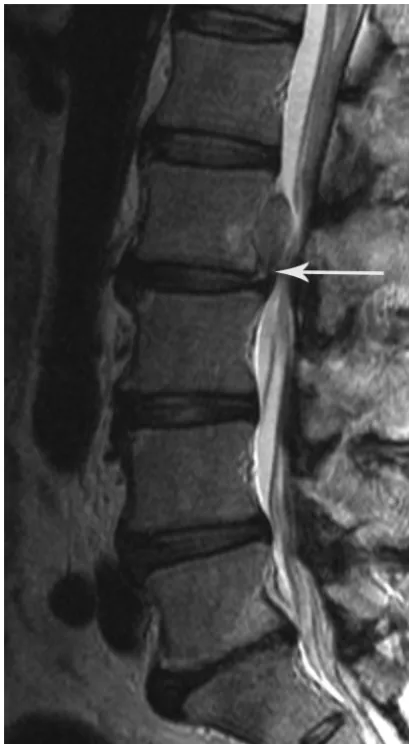 FIG 2. Case 4. Sagittal T2-weighted image shows the height of theabnormal disk herniation (bold arrows) compared with the disk height(thin arrows)