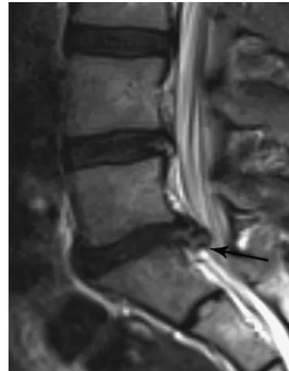 FIG 4. Case 15. Sagittal T2-weighted image shows disruption of outerannulus (arrow) even on retrospective interpretation; thus, the imag-ing classiﬁcation in this case is extrusion