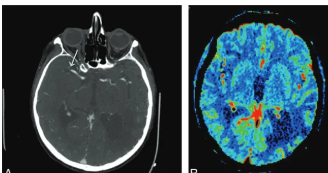 FIG 1. Coronal CTA MIP image and CBV map in a patient with SPAN-100-positivity at presenta-paresis and subsequent unfavorable outcome demonstrates abrupt occlusion of the main stemleft MCA with a collateral score of zero