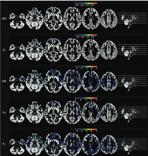 FIG 1. Voxelwise maps of cortical abnormalities in patients with TLE compared with controls