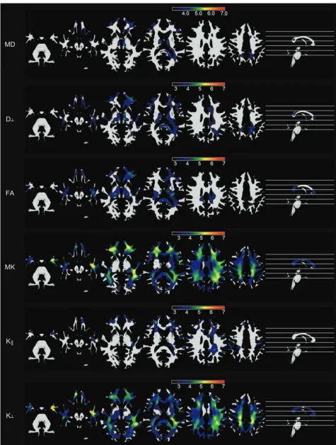 FIG 2. Voxelwise maps of white matter abnormalities in patients with TLE compared with controls