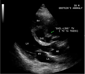 Figure 15. Parasternal long axis view showing the fused tricuspid valve (arrow) in a 28-year old cyanotic male