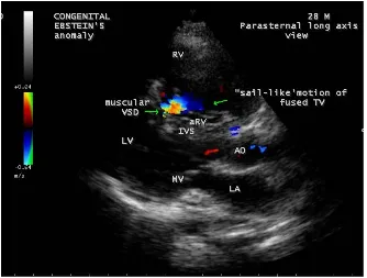 Figure 18. Apical view showing the displacement ratio with mild TR (tricuspid regurgita-tion) in a 28-year old cyanotic male