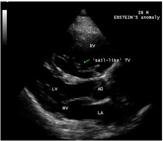 Figure 20. Apical view showing the left ventricular to right atrial communication (dilated atrialized right ventricle) (lower arrow) and the displaced septal tricuspid leaflet (STL) (upper arrow) in 28-year old cyanotic male