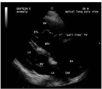 Figure 22. Tilted Parasternal long axis view showing the position of anterior leaflet dur-ing the “sail-like” motion (arrow) in a 28-year old male [5]