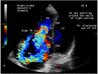 Figure 6. Continuous Wave (CW) Doppler (green line) showing the low pressure TR (tricuspid regurgitation) jet in a 22 year old acyanotic male