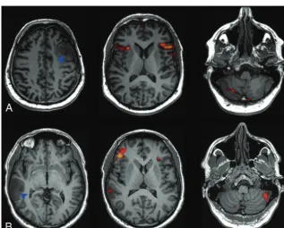 FIG 2. Scatterplot of the healthy participant lateralization indices of the cerebrum andcerebellum.