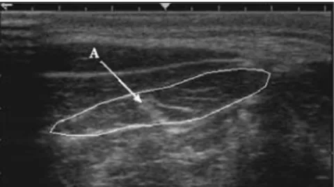 FIGURE 10. Transverse ultrasound image of the left semispinalis capitis muscle, a long strap-like muscle, using a 7.5-MHz linear transducer
