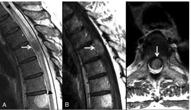 FIG 2. The presence of multiple ISCMs was a poor prognostic indicator. A 76-year-old man withCompared with solitary ISCMs, multiple ISCMs were associated with decreased survival