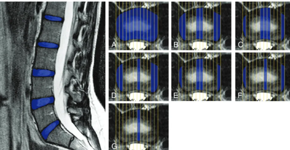 FIG 1. On the left is a sagittal T2-weighted image representing the segmented region of the intervertebral disk