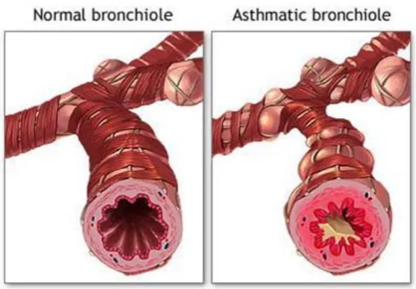 Figure 1.1. Illustration of the pathophysiology of asthma (A.D.A.M, 2007). 