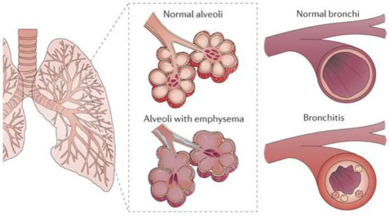 Figure 1.2. Illustration of the pathophysiology of COPD (Houghton, 2013). 