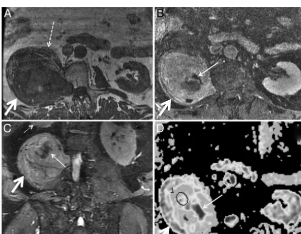 FIG 4. Metastatic renal cell carcinoma in a 46-year-old woman with left arm weakness. Axial STIR (A), axial fat-saturated postgadolinium T1 (B),axial DWI (C), and axial ADC (D) demonstrate a T2 hyperintense, enhancing mass (arrows) along the left C6 nerve 