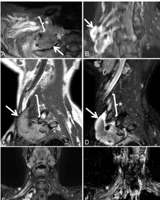 FIG 8. Postradiation brachial plexopathy in a 42-year-old woman with progressive right upperextremity weakness, beginning in the hand and progressing proximally