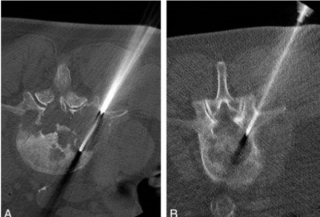 FIG 1. A, Axial CT performed with the regular-dose technique (kVp 120, mAs 250) demonstratesa biopsy needle within a lytic lesion in L3 vertebral body